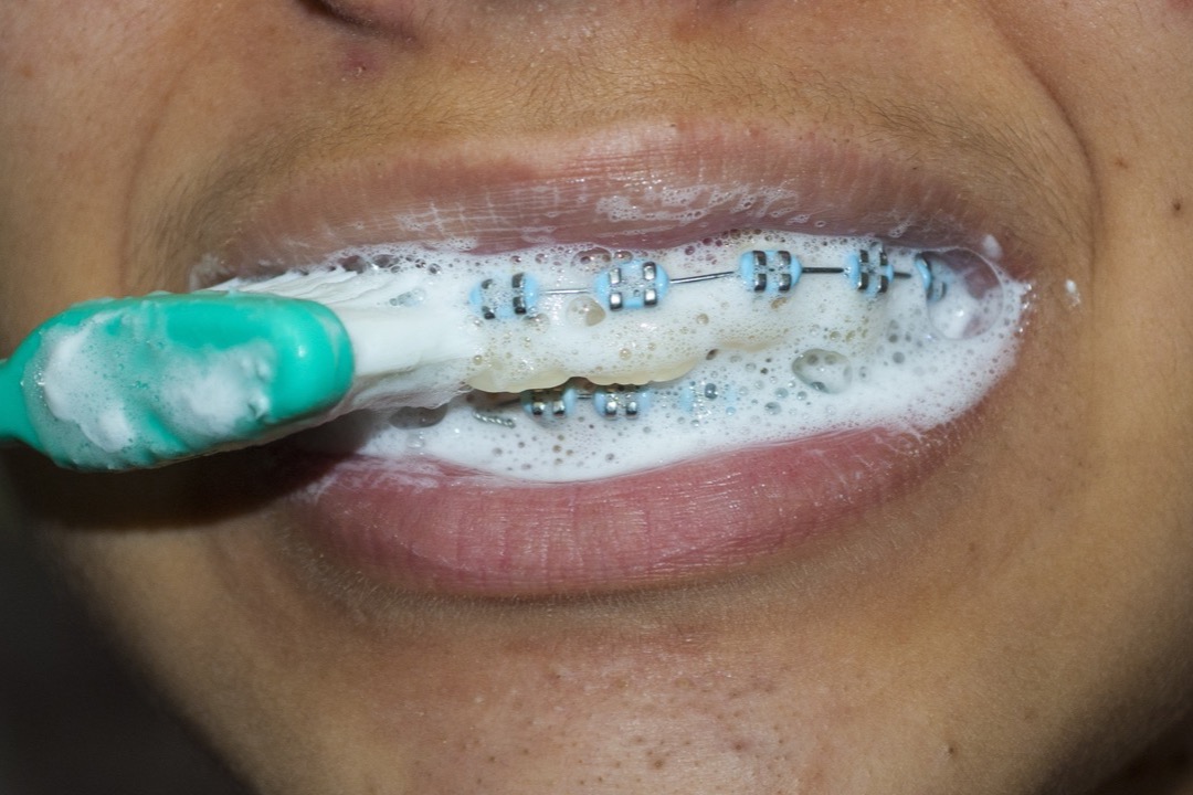 Toothbrush cleaning teeth fitted with metal orthodontic brackets and archwire